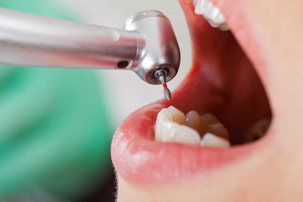 Best Emergency Wisdom Teeth Removal in Winston, OR
